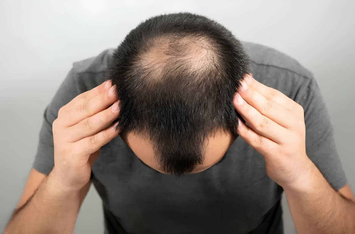 Scalp getting visible?
