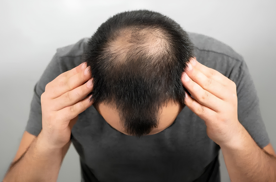 Scalp getting visible?